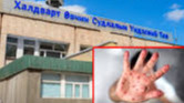 Улаанбурхны лабороториор батлагдсан 85 тохиолдол бүртгэгджээ